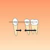 矯正歯科に用いるアンカーについて