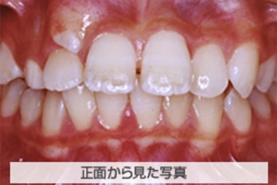 上顎前突(出っ歯)の治療例