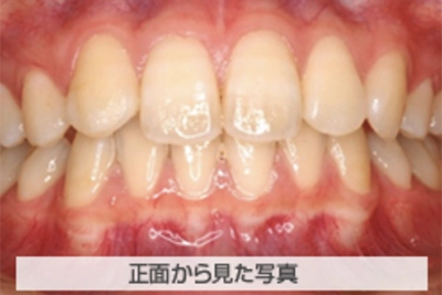 上顎前突(出っ歯)の治療例