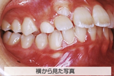 上顎前突(出っ歯)の治療例