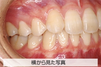 上顎前突(出っ歯)の治療例
