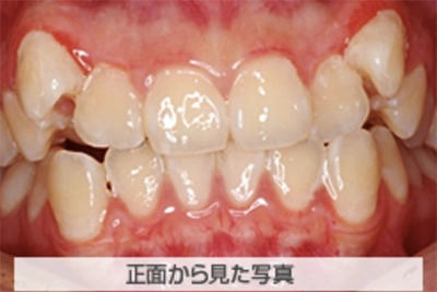 叢生(でこぼこ)の治療例