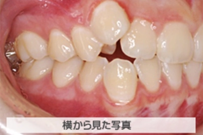 叢生(でこぼこ)の治療例