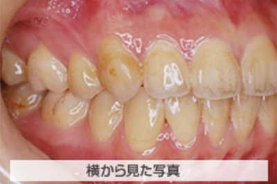 叢生(でこぼこ)の治療例
