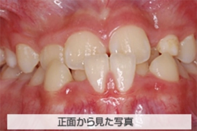 受け口の治療例