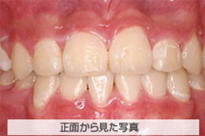 受け口の治療例