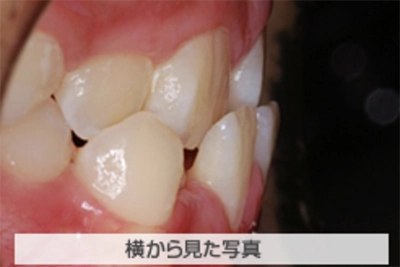 受け口の治療例