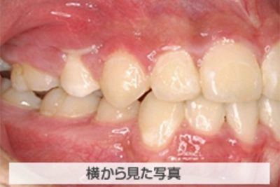 受け口の治療例