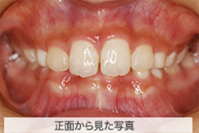 MIX上顎前突の治療例