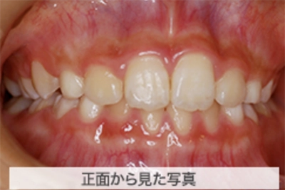 MIX上顎前突の治療例