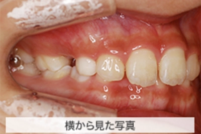 MIX上顎前突の治療例