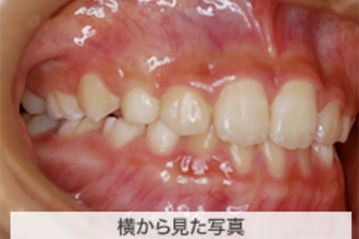 MIX上顎前突の治療例