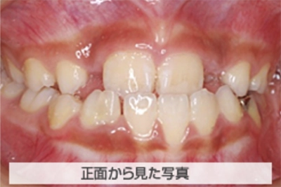 MIX反対咬合の治療例