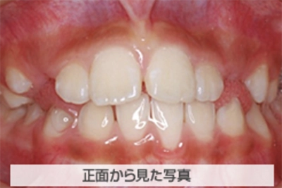 MIX反対咬合の治療例