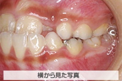 MIX反対咬合の治療例