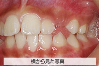 MIX反対咬合の治療例
