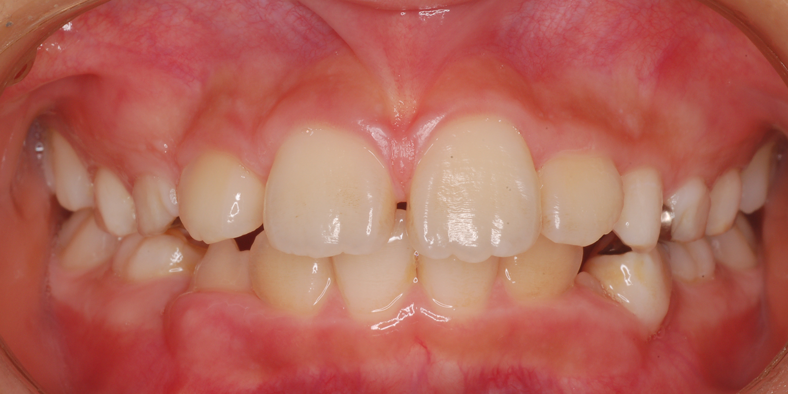 叢生・ガタガタの歯並びの治療