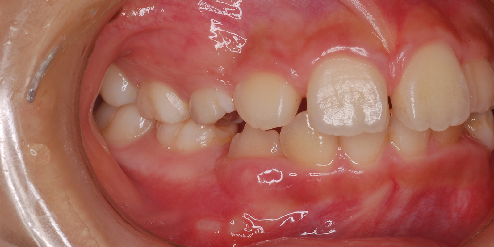 叢生・ガタガタの歯並びの治療