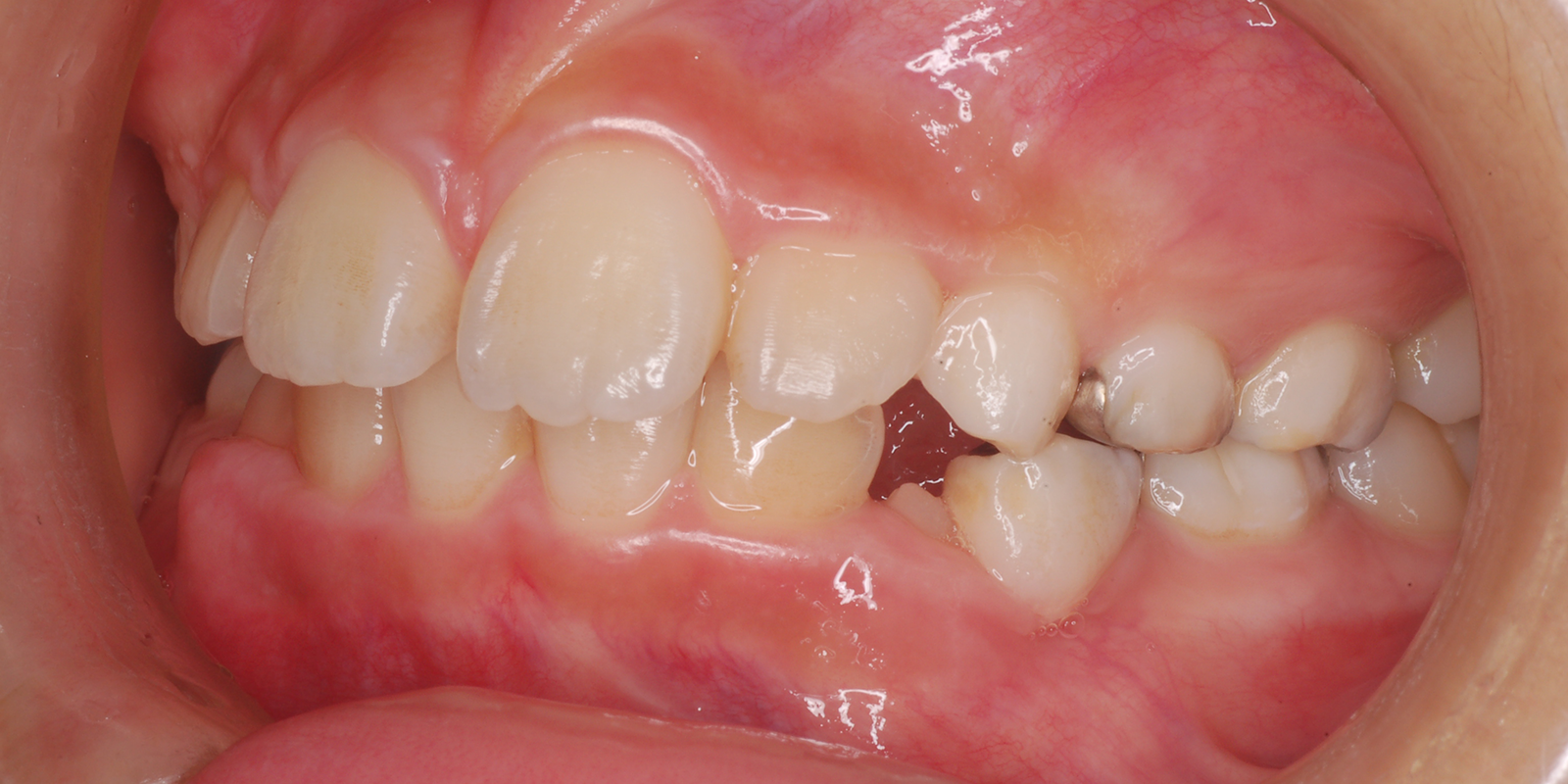 叢生・ガタガタの歯並びの治療