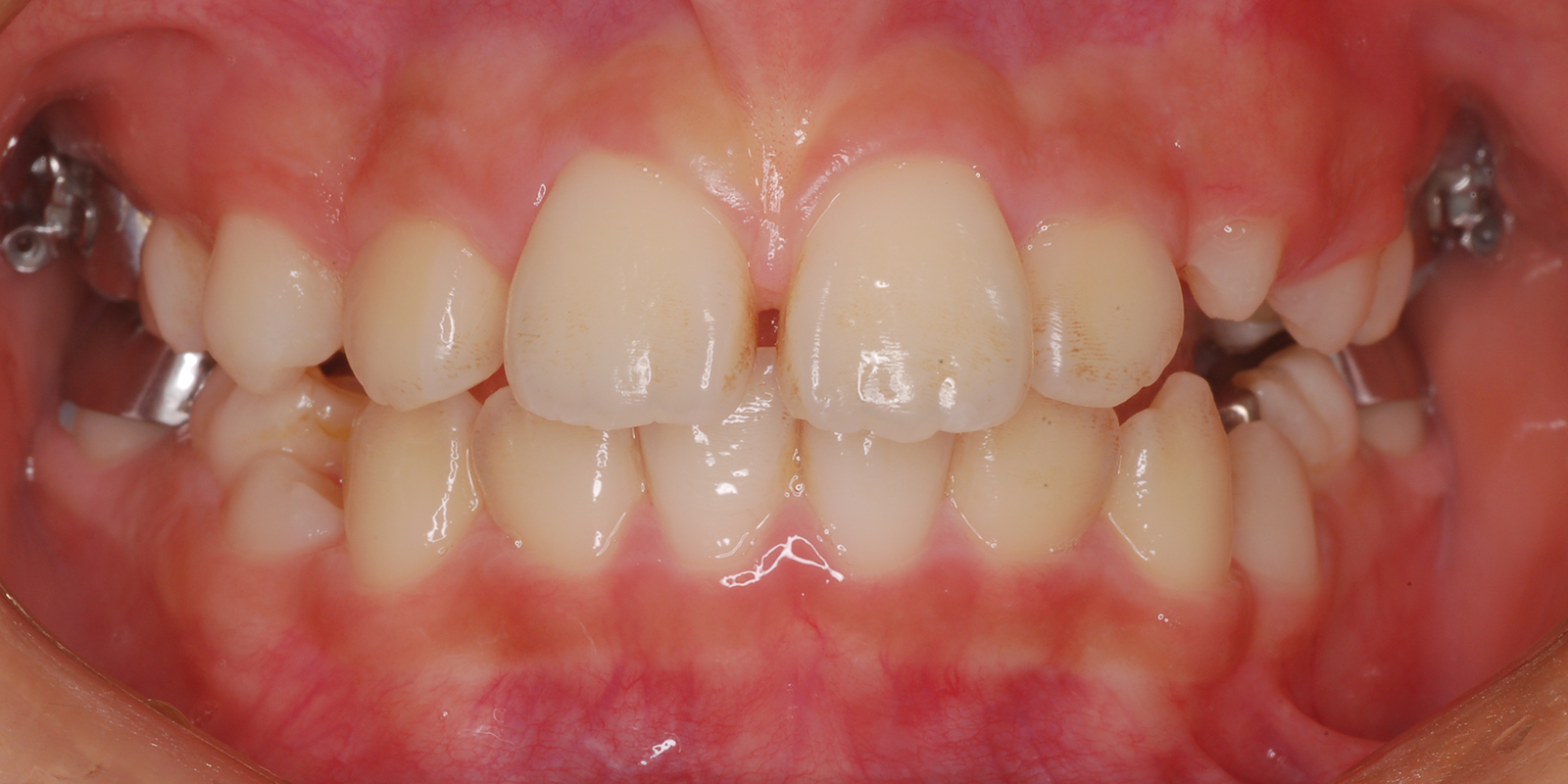 叢生・ガタガタの歯並びの治療