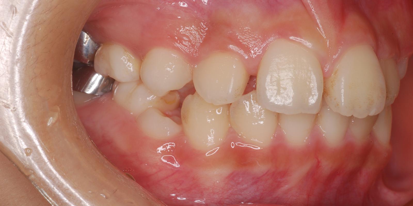 叢生・ガタガタの歯並びの治療