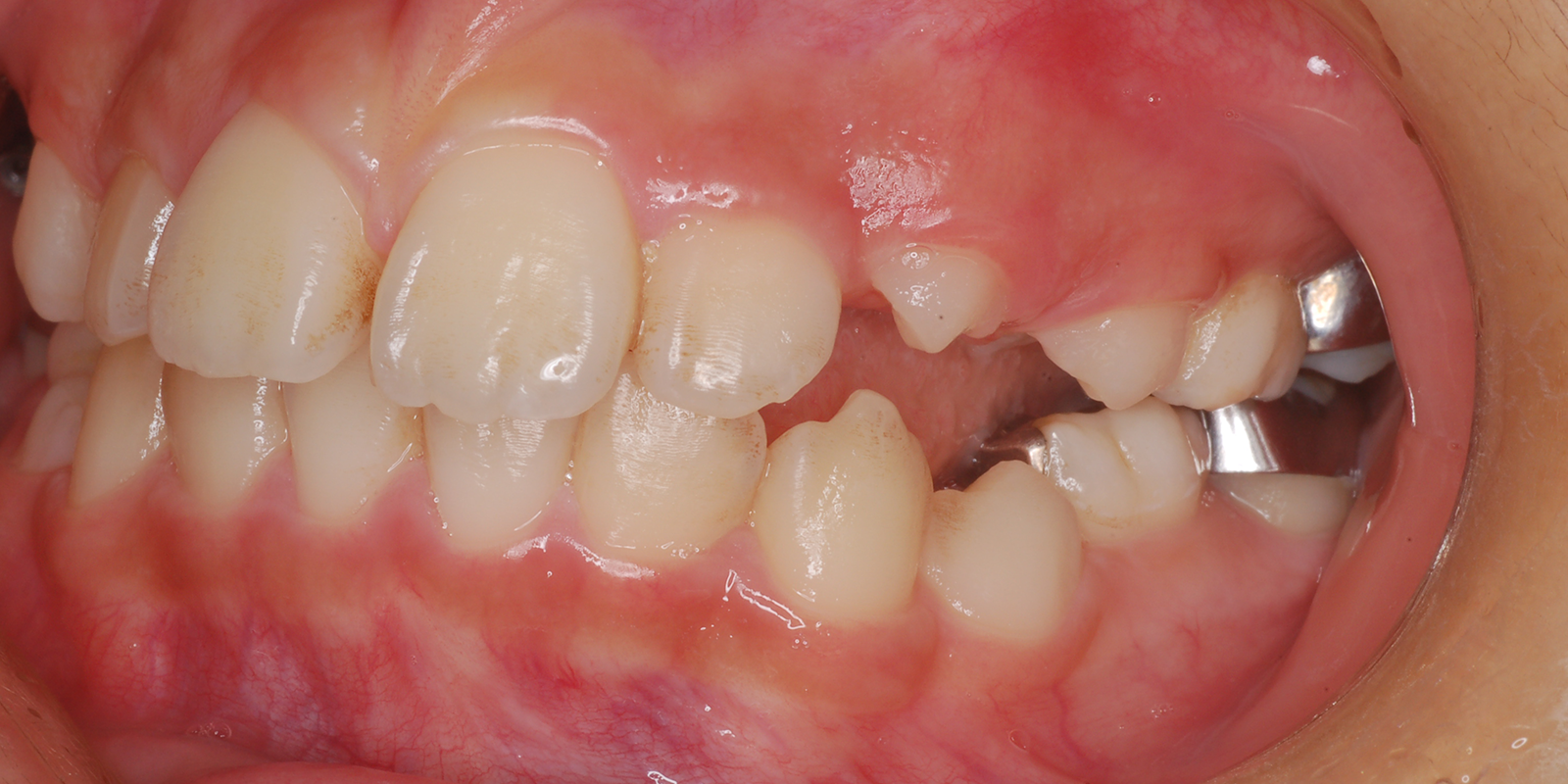 叢生・ガタガタの歯並びの治療