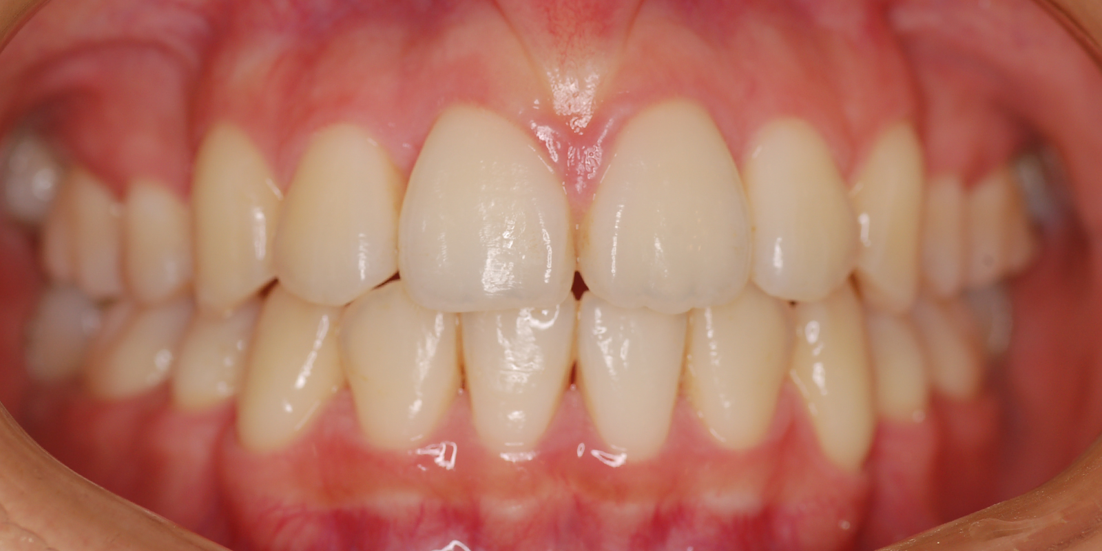 叢生・ガタガタの歯並びの治療