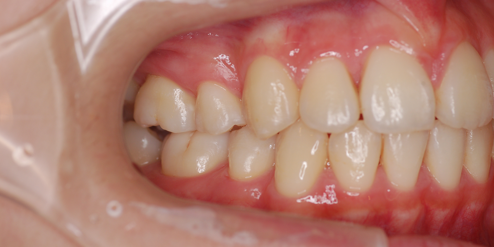 叢生・ガタガタの歯並びの治療