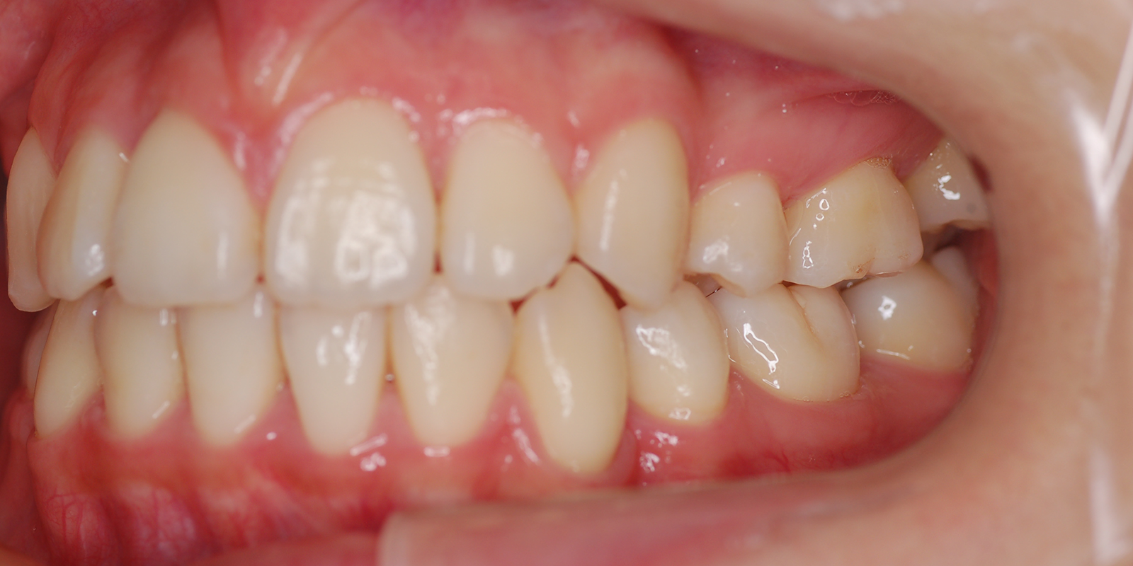 叢生・ガタガタの歯並びの治療