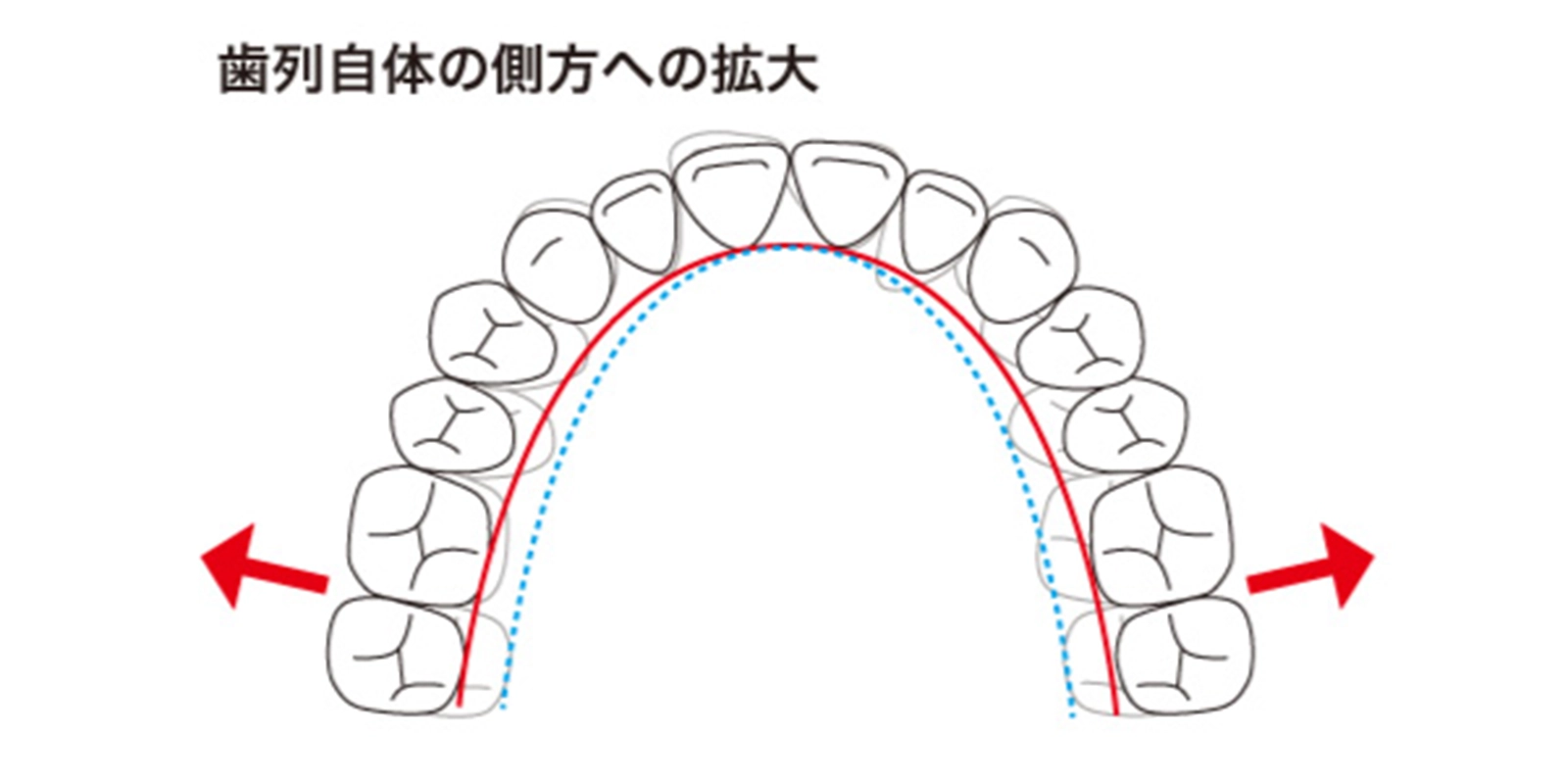歯列自体の側方への拡大