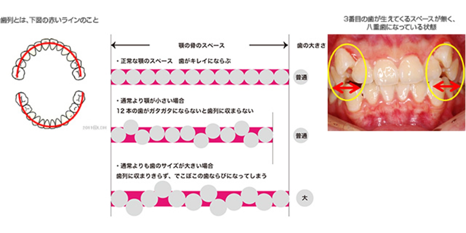 歯列を拡大する