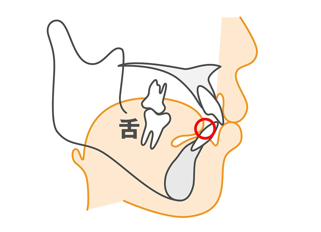 間違った舌の位置