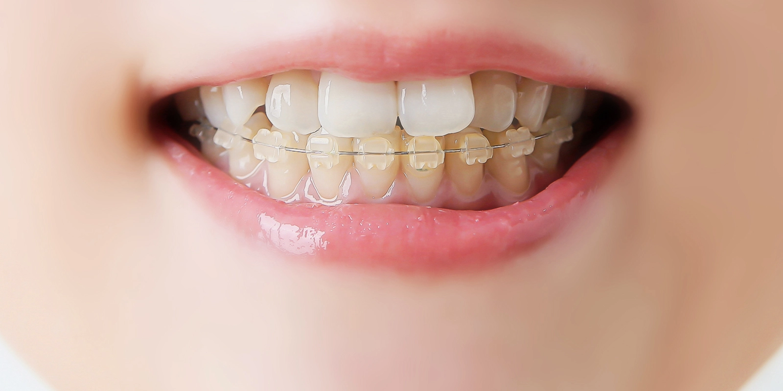 外科矯正とは?顎変形症に対する根本的な治療法